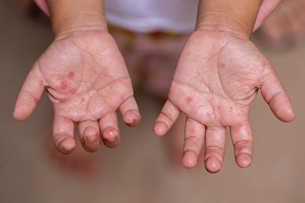 手足口病の子どもの手のひらに見られる小さな発疹や水疱