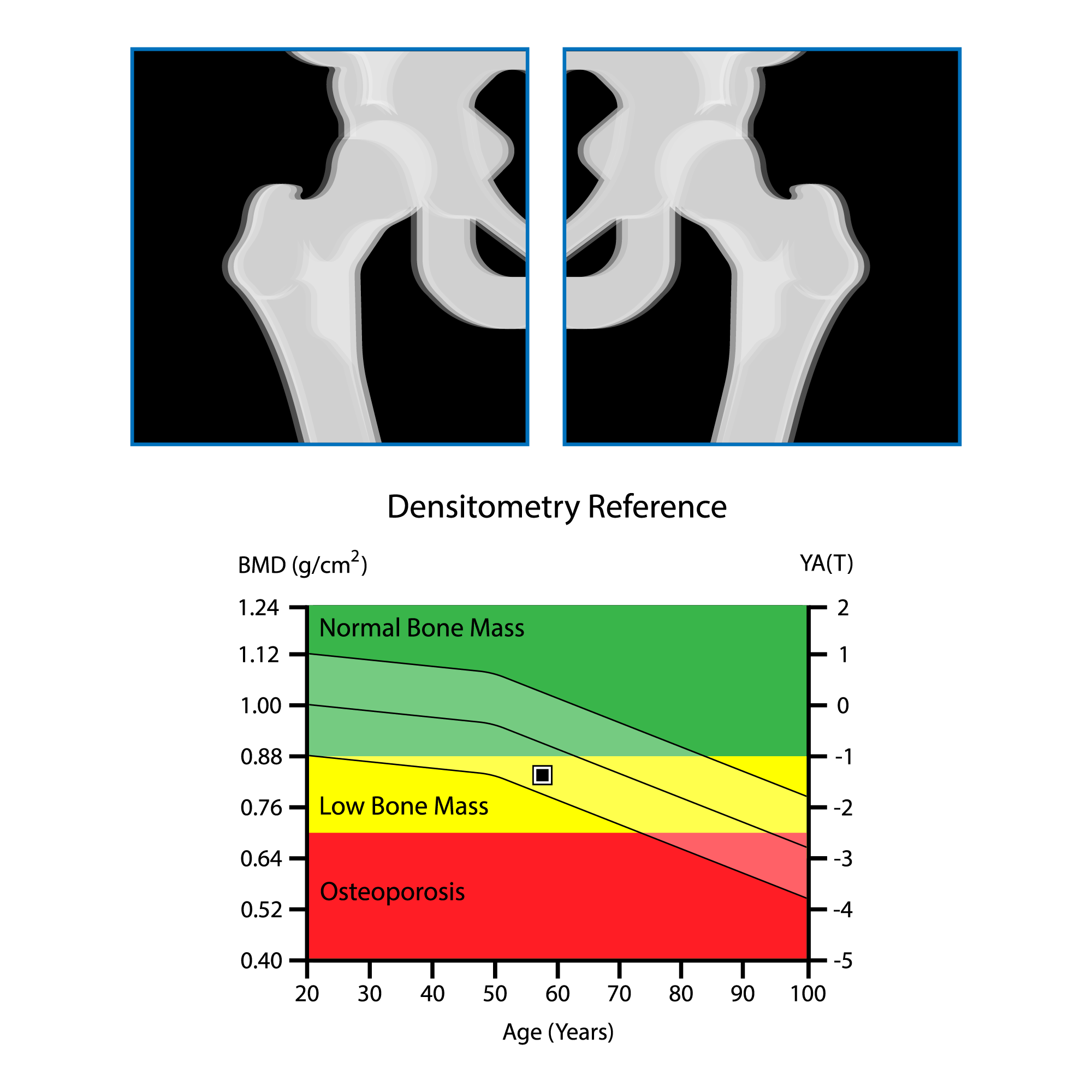 bone-density-t-score-dxa-classification-osteoporosis | 芦屋市の内科・皮膚診療・小児診療 | あしやサニークリニック内科 骨密度(BMD)とTスコアによる骨密度分類を示す図。正常骨量、骨減少(骨量減少)、骨粗鬆症の基準を年齢とともに示している。